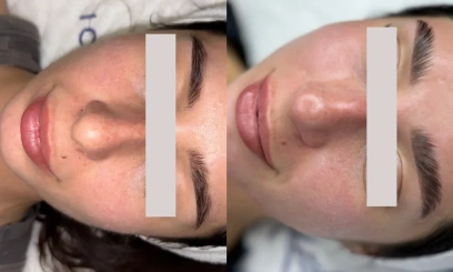 Уход Couperose therapy от  REVIDERM Уход Couperose therapy от  REVIDERM